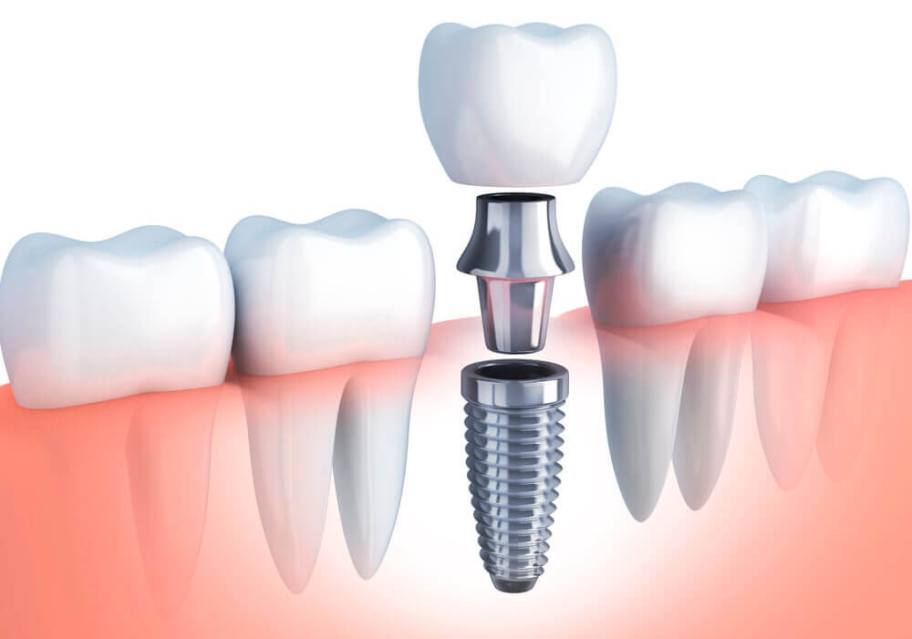 Как устанавливают зубные импланты? — Ответы на вопросы врачей  стоматологической клиники Миллидент в Казани