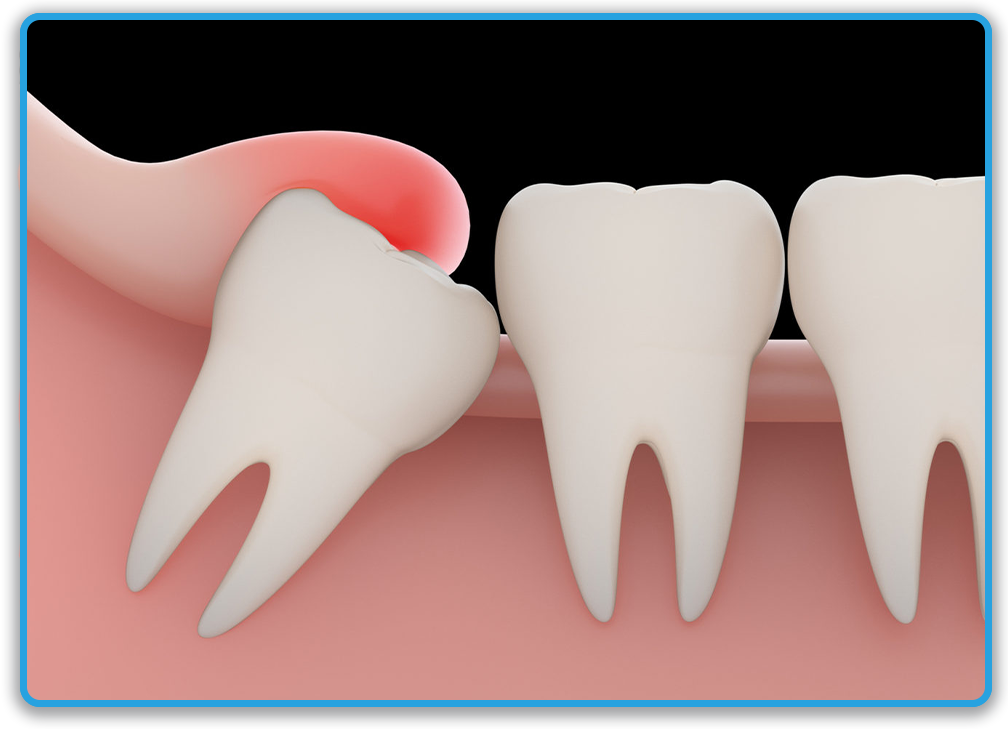 Сложное удаление зуба — показания, этапы и особенности операции