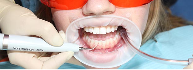 Чистка зубов в кабинете стоматолога с помощью технологии Air Flow в  стоматологии Миллидент ☎ +7 (843) 204 09 84