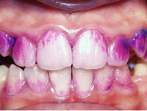 Фото по лечению зубов у детей до и после